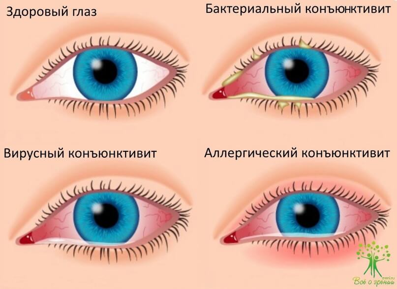 Виталайн (Vitaline) при заболеваниях глаз